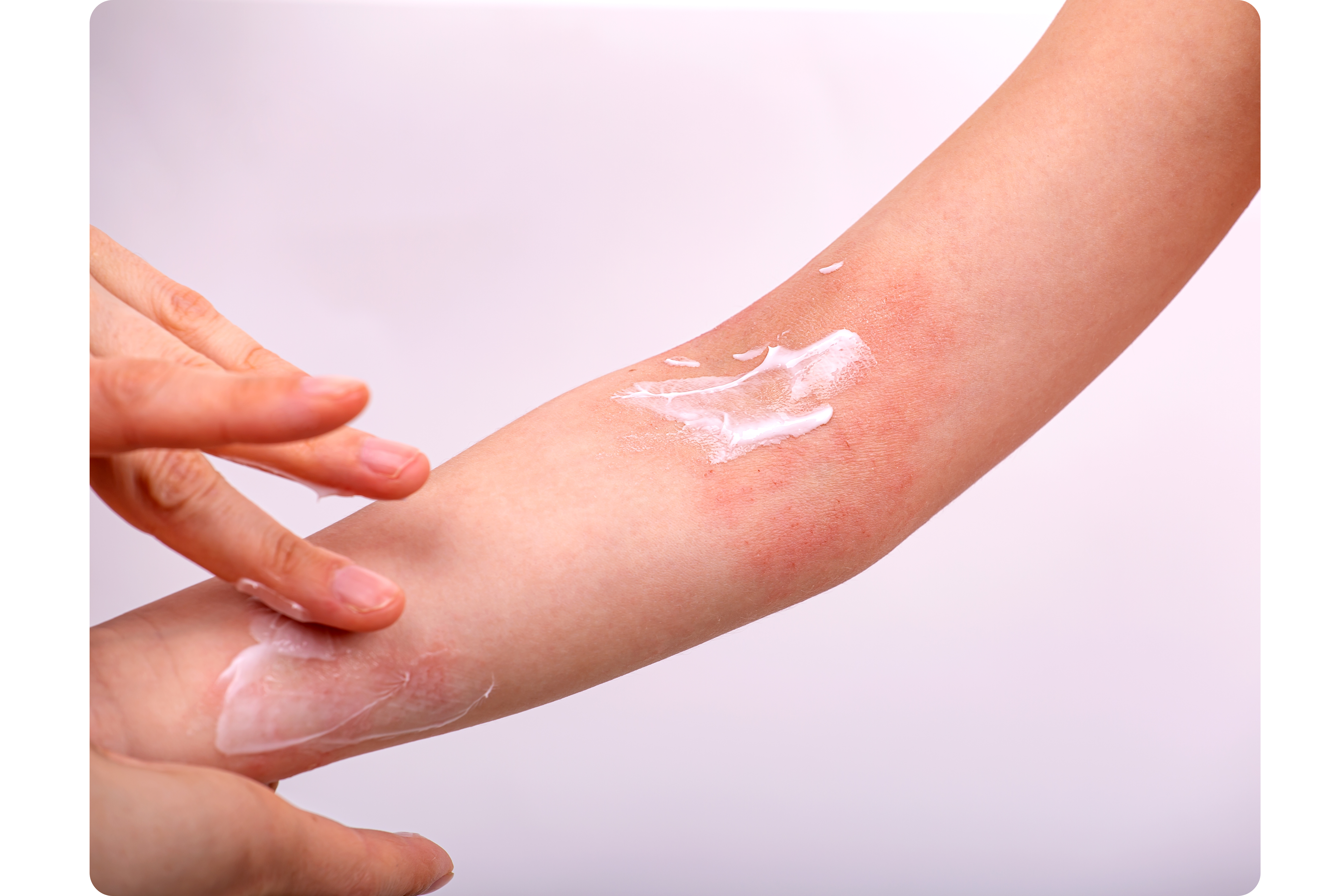 ointment applied on the skin