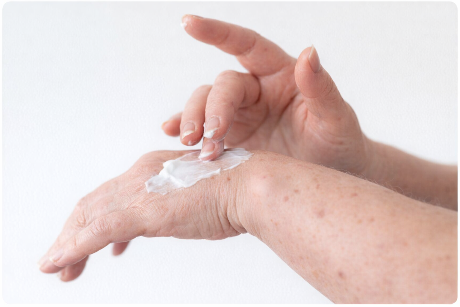 Topical cream beina pplied to the skin